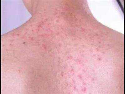 記住這四句話可以祛除體內的濕毒