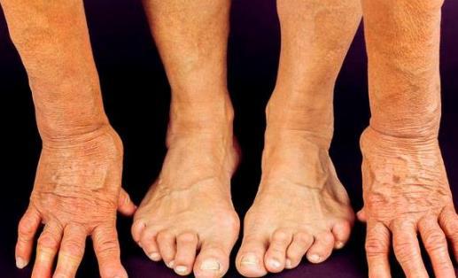 風濕有哪些治療方法風濕患者用什么好