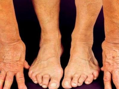 風(fēng)濕有哪些治療方法風(fēng)濕患者用什么好