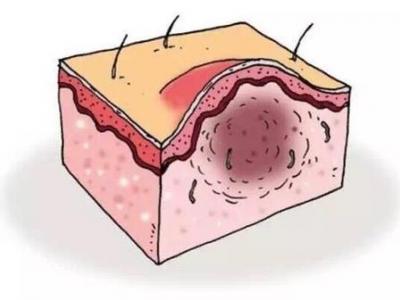 毛囊炎反復(fù)發(fā)作的原因以及治療方法