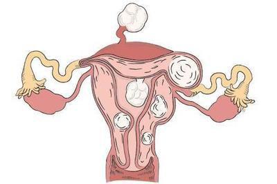 小的子宮肌瘤可以通過這樣食療進行改善