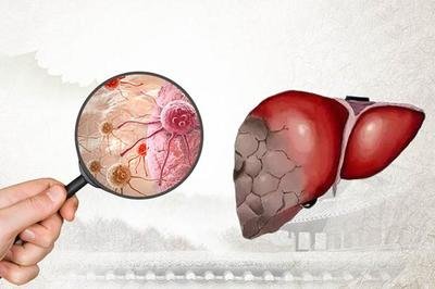 肝病有哪些病肝病具體分為哪些種類-易網健康<a href=http://www.logojc.com/jkys/ target=_blank class=infotextkey>養生</a>網 肝病有哪些病肝病具體分為哪些種類