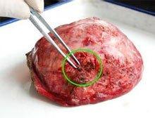 肝上有結節嚴重嗎肝結節一定是肝癌嗎