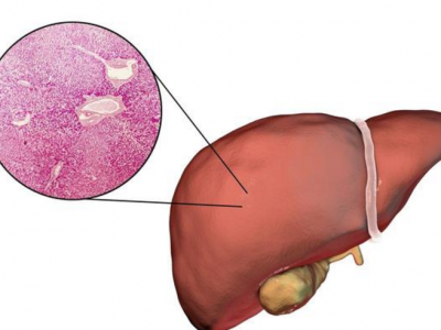 肝臟不好的人早晨起床會(huì)有這六個(gè)癥狀