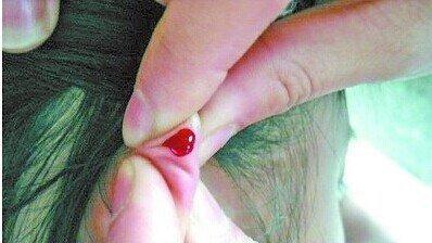 放血療法的效果放血療法可以治療哪些疾病