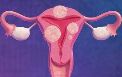 這七類女性是子宮肌瘤的高發人群