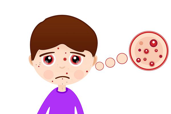 額頭長痘痘是什么緣故