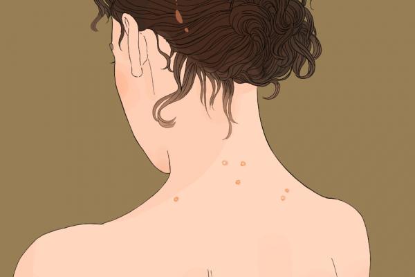 上火長(zhǎng)痘痘怎么調(diào)理去火 上火冒痘吃什么降火