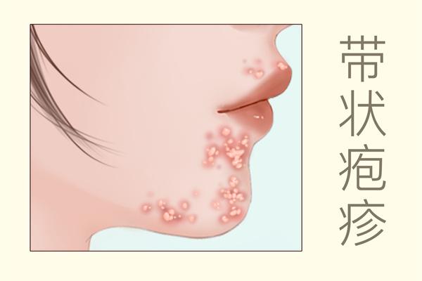 帶狀皰疹能吃羊肉嗎