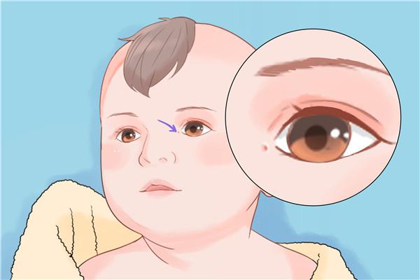 先天性馬蹄內翻足表現