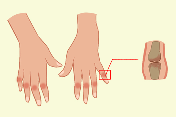 痛風能不能吃辣條