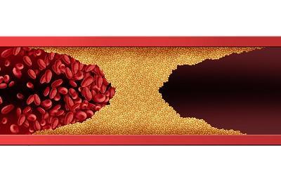 膽固醇高說白了就是缺蛋白質(zhì)嗎 導(dǎo)致膽固醇高的三大原因