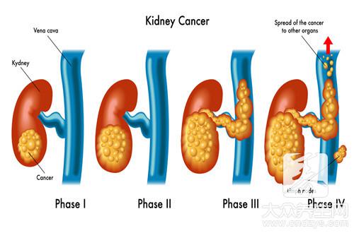 腎病影響性功能嗎