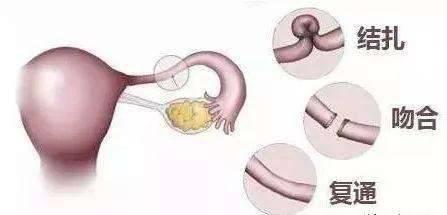女性結扎會不會影響夫妻性生活，到底結扎對女人有什么危害