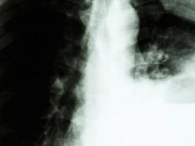 肺癌患者可以過性生活嗎？你知道為什么肺癌不傳染嗎？