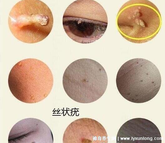 男性疣是什么樣子圖片，尖銳濕疣/扁平疣/絲狀疣發(fā)病部位不同
