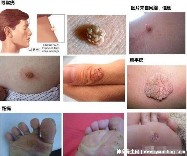 男性疣是什么樣子圖片，尖銳濕疣/扁平疣/絲狀疣發(fā)病部位不同