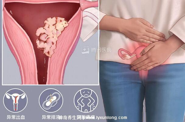 真實宮頸癌的早期出血圖片，接觸性出血是最明顯癥狀(女性必看)