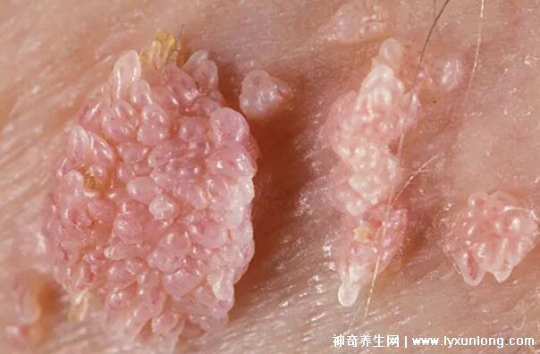 男性疣是什么樣子圖片，尖銳濕疣/扁平疣/絲狀疣發(fā)病部位不同