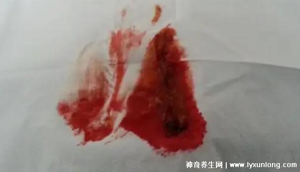 宮頸癌褐色分泌物圖片，少量不規(guī)則出血伴隨X交痛(腥臭分泌物)