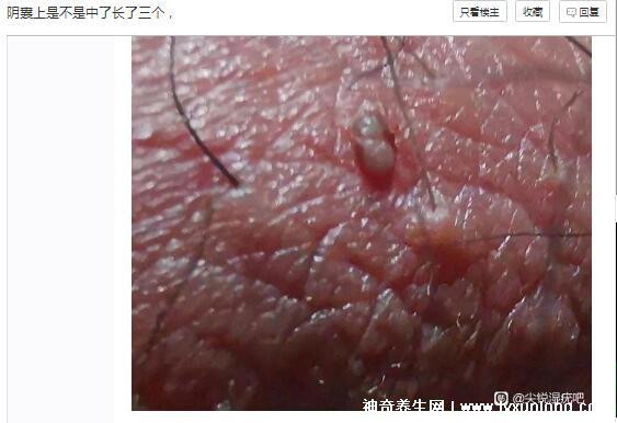 男性早期圖片尖濕銳疣長在哪，生zhi器甚至是口腔(菜花狀疣體出血)