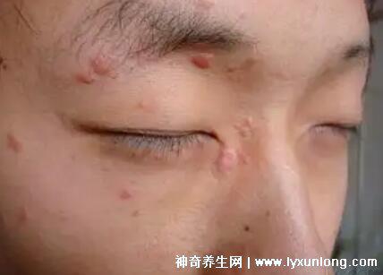 男性疣是什么樣子圖片，尖銳濕疣/扁平疣/絲狀疣發(fā)病部位不同