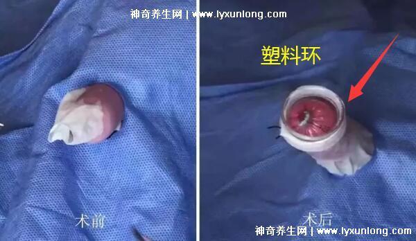 成年男子割包好處和壞處，8種情況必須割(附割包照片真實)