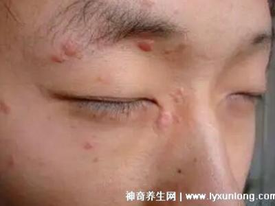 男性疣是什么樣子圖片，尖銳濕疣/扁平疣/絲狀疣發(fā)病部位不同