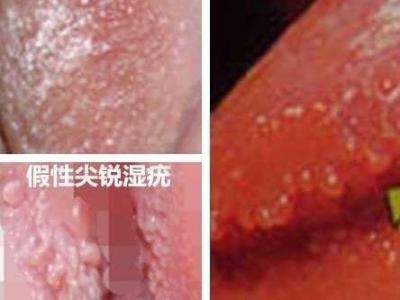 女性假疣和真疣的圖片對比，前者淡紅色和淡褐色魚子狀(5大區別)