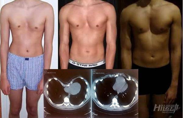 高個子健身本來就難！還因漏斗胸自斷10根肋骨治療