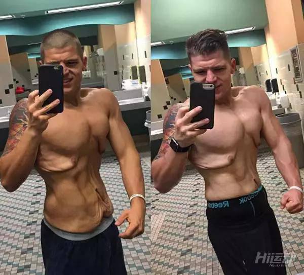 胖子成功減肥200斤，皮膚松弛也坦然面對！