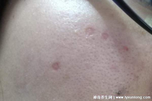 千萬不要激光點痣后悔一輩子，可導致惡性黑色素瘤(共3個危害)