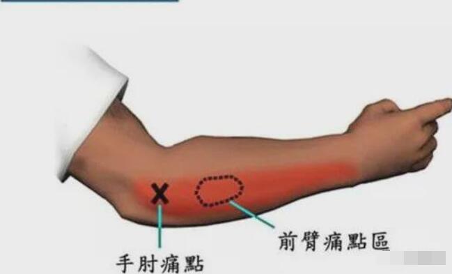 網(wǎng)球肘最怕三個動作，反手拍球/手腕彎曲/提重物/做家務(wù)
