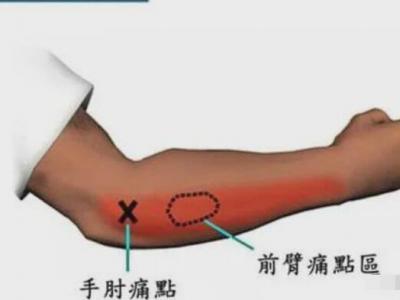 網(wǎng)球肘最怕三個動作，反手拍球/手腕彎曲/提重物/做家務(wù)