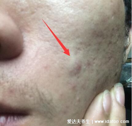 暗瘡圖片是什么樣子，暗瘡和痤瘡有區別(不形成膿包)