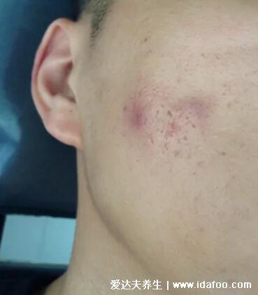 暗瘡圖片是什么樣子，暗瘡和痤瘡有區別(不形成膿包)