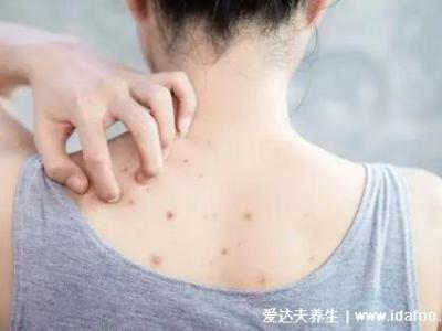 暗瘡圖片是什么樣子，暗瘡和痤瘡有區別(不形成膿包)