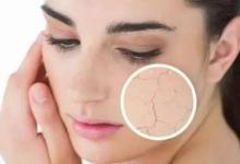  女性皮膚干燥怎么辦？ 如何改善？