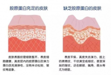 注射膠原蛋白真的能改善臉部皺紋？