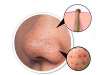 鼻子上的黑頭如何去除 幾個簡易方法請收好