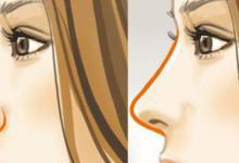 隆鼻多久可恢復？別忽視這3種后遺癥
