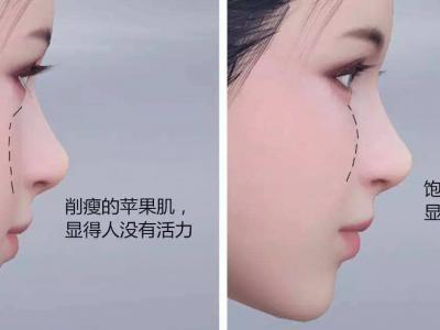 為什么蘋果肌填充之后 臉部顯著不自然？