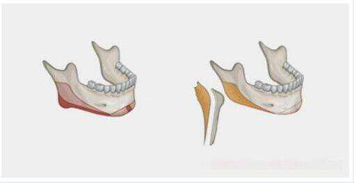 削骨瘦臉 術后3件事一定要做好