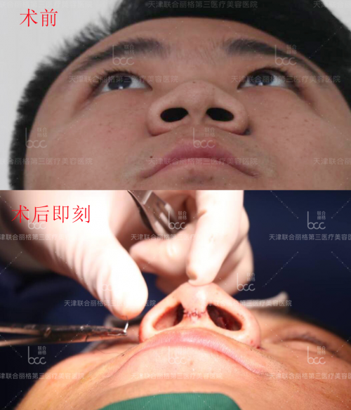 關于『 萌芽仿生綜合隆鼻術(shù)』你想知道的都在這里！