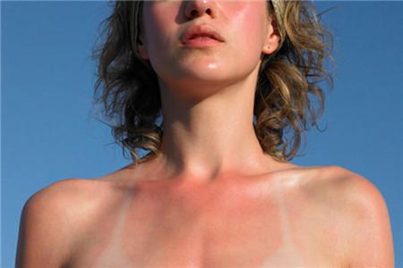 肌膚曬傷之后的幾個有效修復方法，不要輕視這個問題