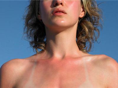 肌膚曬傷之后的幾個有效修復方法，不要輕視這個問題