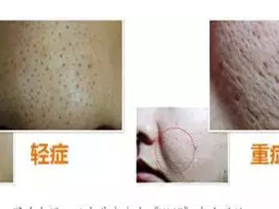 肌膚毛孔空隙的三種不同類型，女性都想了解的護膚小知識