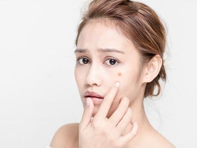 面部痤瘡如何治療，女性針對不同膚質進行治療最佳方法