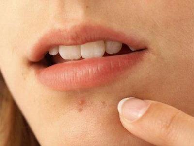 面部痤瘡下巴長痘，鼻子長黑頭，最佳的治療方式是選擇它