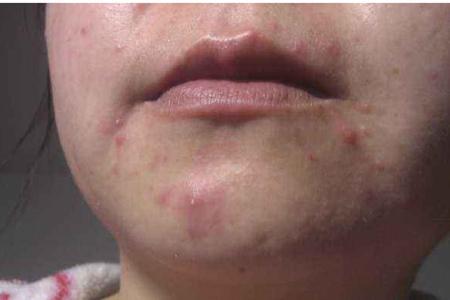 女性下巴長痘，原來是身體這里出問題，教你五招去除痘痘